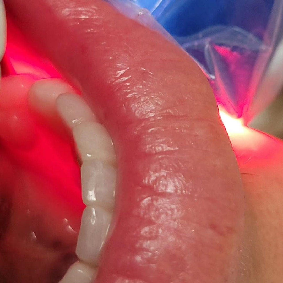 pbm HEALING LEDライトセラピー装置 パーキンソン病治療用LEDライトセラピーヘルメット - 中国 光
